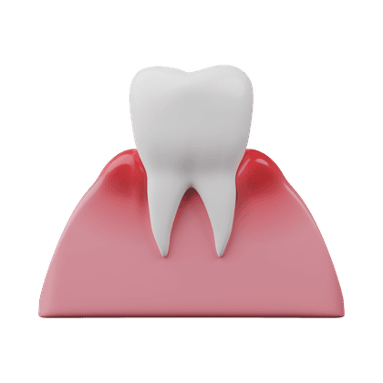 Zahnfleischentzündung, Gingivitis, Parodontitis