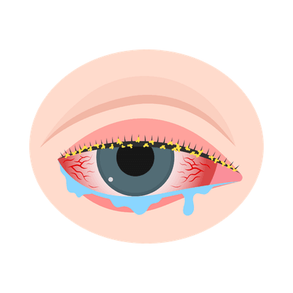 Conjuntivitis